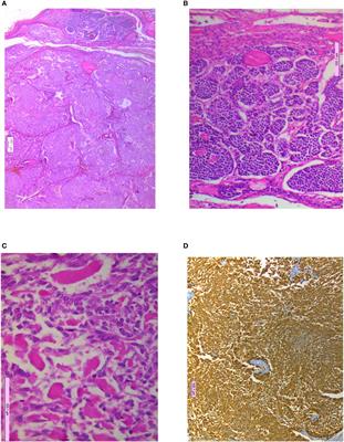 An audit of medullary thyroid carcinoma from a tertiary care hospital in northwest India